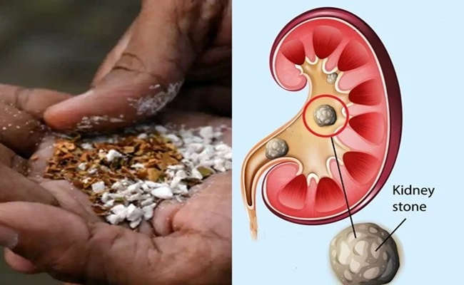 Pan Masala can Cause Larger Kidney Stones: Experts